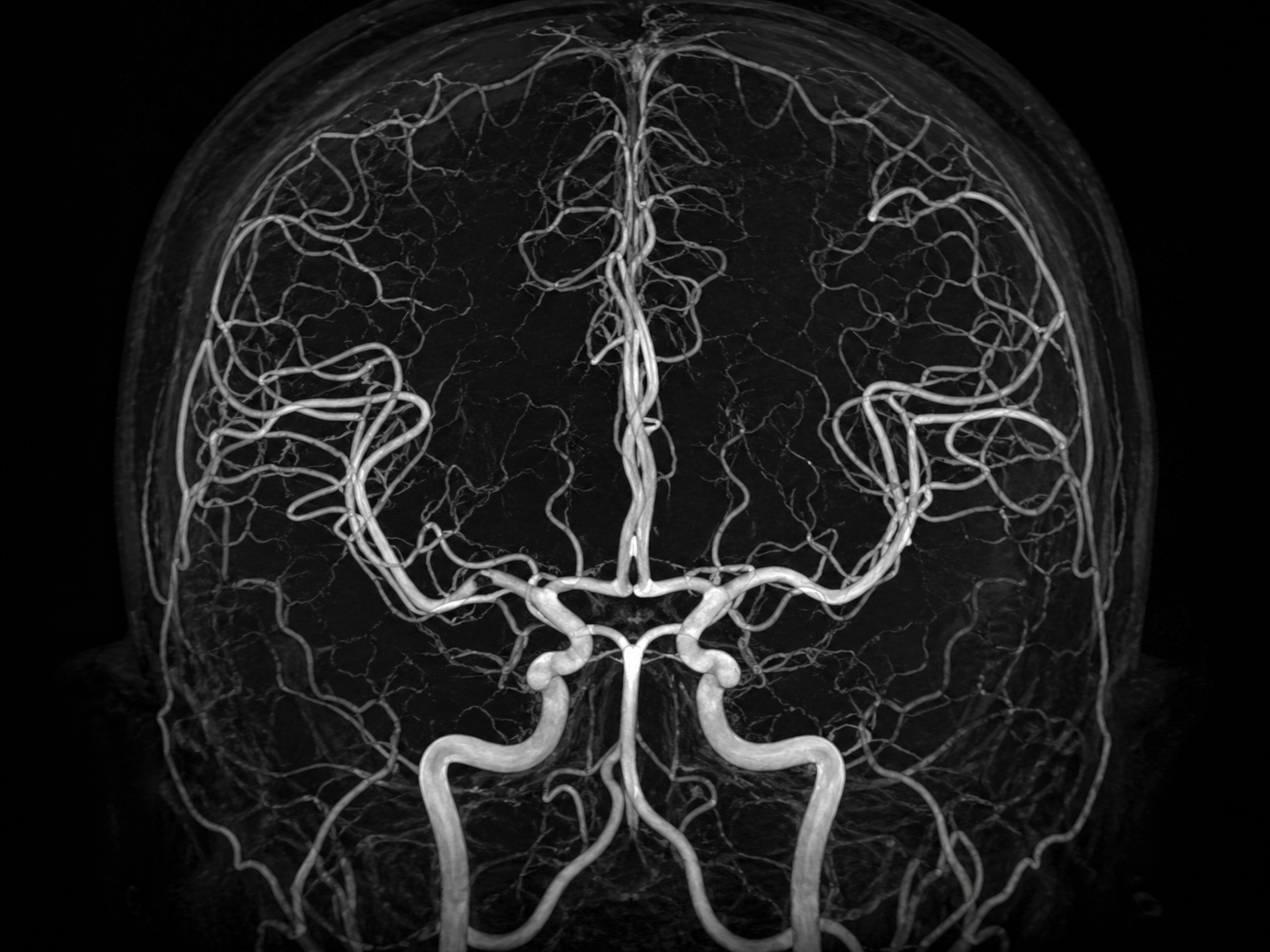 Arteriografia - Aneurisma Cerebral