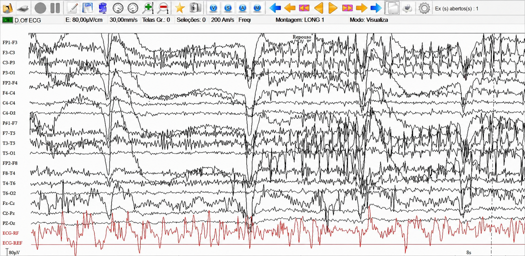 Eletroencefalograma - Epilepsia
